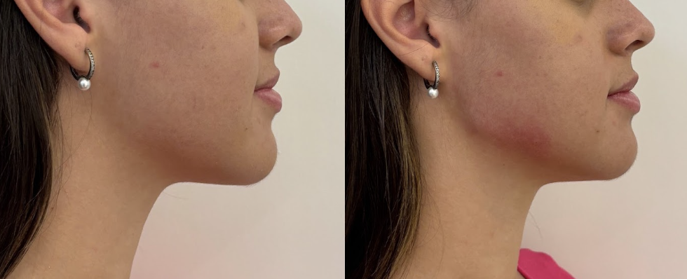 Antes — Perfil com enquadramento do nariz para baixo