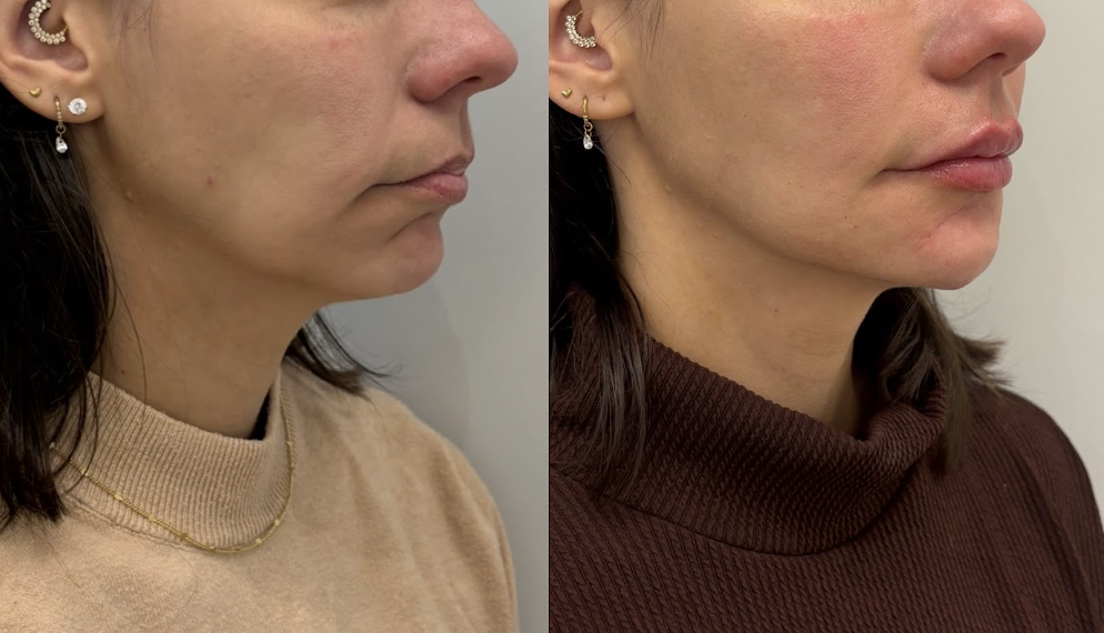 Antes — Lábios e contorno inferior da face, do nariz para baixo