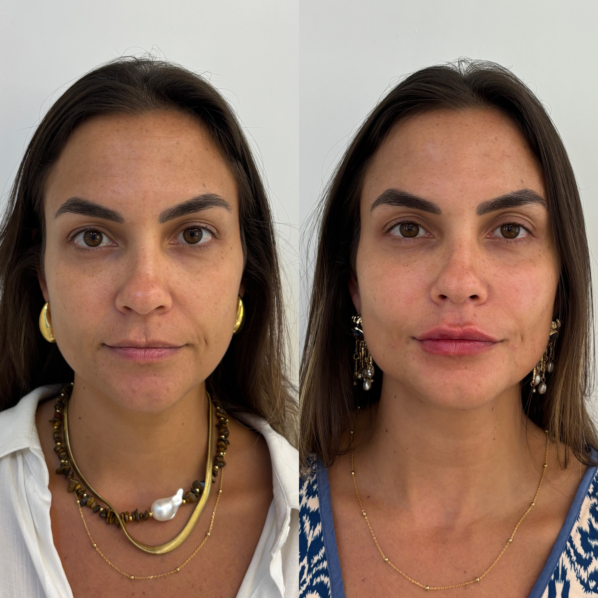 Antes — Região perioral antes, do nariz para baixo