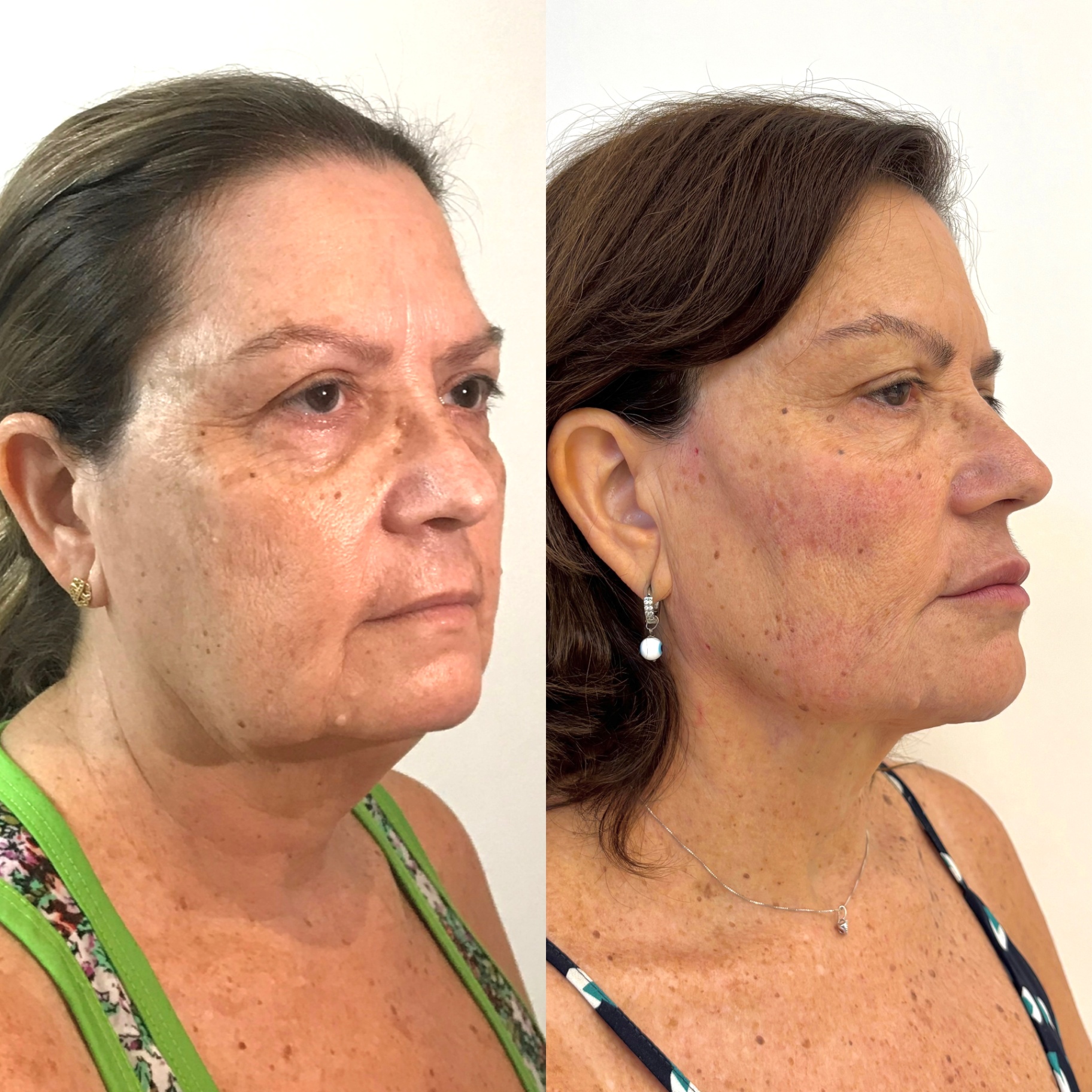 Antes — Perfil antes, com enquadramento abaixo dos olhos